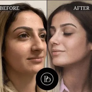 PRP Treatment in Dubai for Stretch Marks and Skin Repair