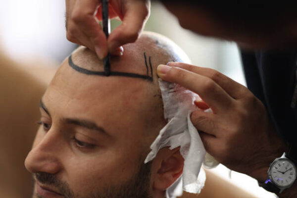 Hair transplant in Dubai