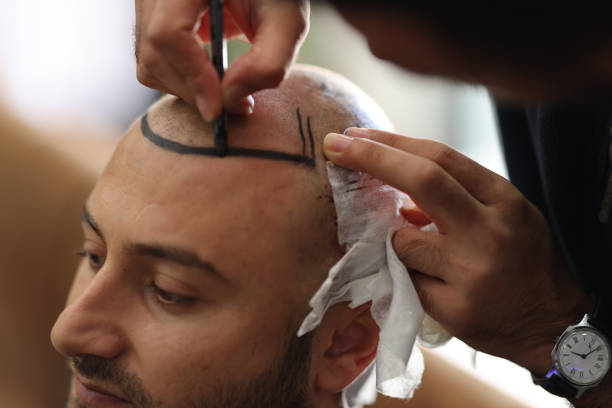 Hair transplant in Dubai