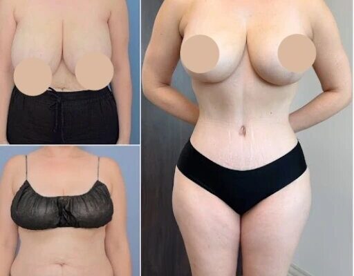 Why the Best Tummy Tuck Surgeons in Dubai Should Be Your First Choice Tummy Tuck in dubai