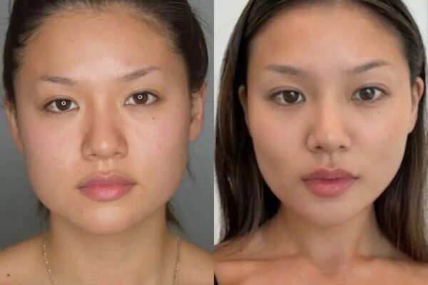 Celebrity Influence on Buccal Fat Removal in Dubai Buccal Fat Removal