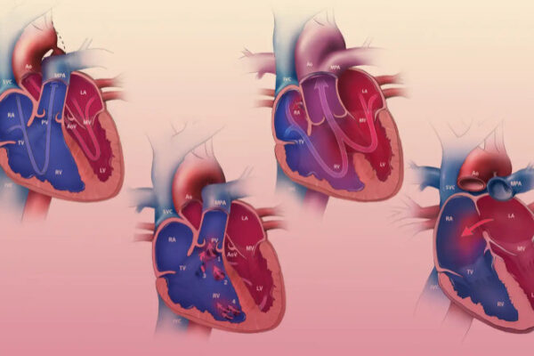 Congenital Heart Disease: Symptoms & Treatment Congenital Heart Disease: Symptoms & Treatment