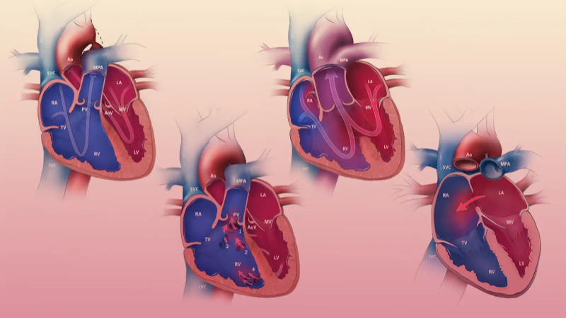 Congenital Heart Disease: Symptoms & Treatment