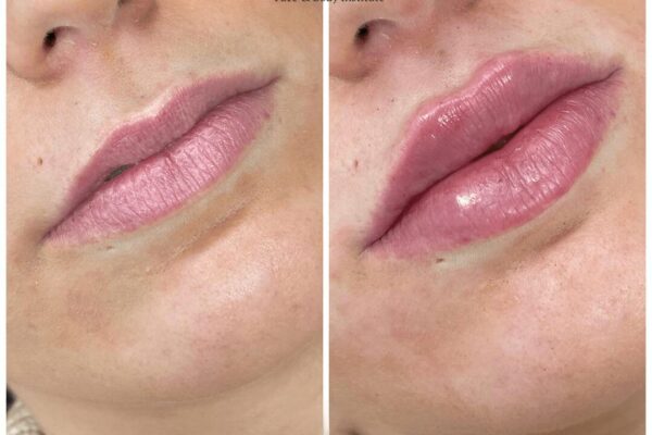 Juvederm