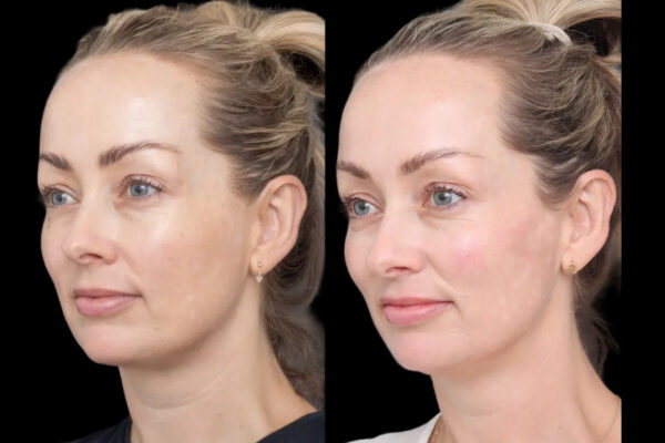 How the Best Doctors in Dubai Customize Cheek Fillers Treatments for You Cheek Fillers in Dubai