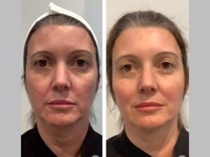 Thread Lift Treatments in Dubai Offer Safe and Effective Non-Surgical Facelifts