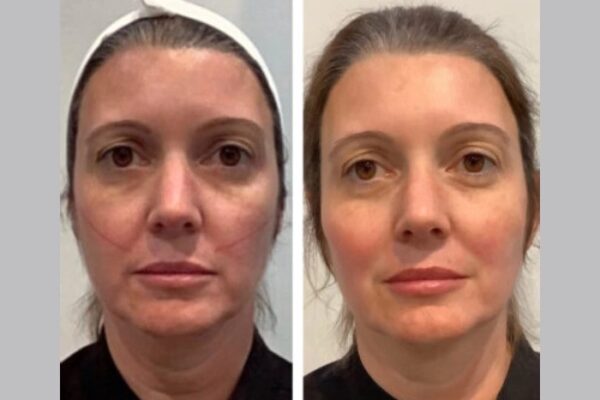 Thread Lift Treatments in Dubai Offer Safe and Effective Non-Surgical Facelifts Thread Lift Treatments in Dubai Offer Safe and Effective Non-Surgical Facelifts