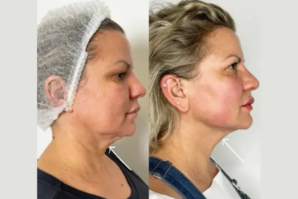 What Makes Endolift in Dubai the Go-To Treatment for Natural Lifting?