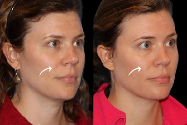 Best Doctors in Dubai Discuss Sculptra’s Poly-L-lactic Acid Base sculptra in dubai