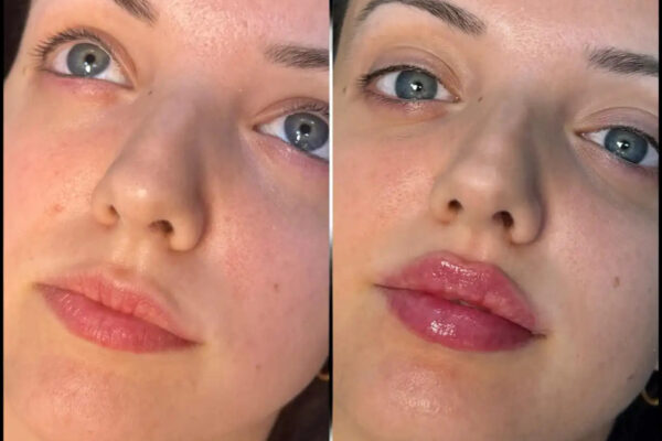 Best Fillers Clinic Where the Best Doctors in Dubai Trust Their Patients Fillers in Dubai