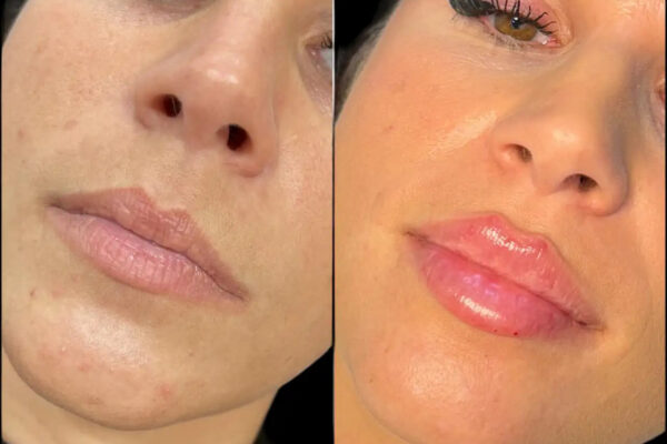 The Science Behind Effective Fillers Treatment in Dubai Fillers in dubai