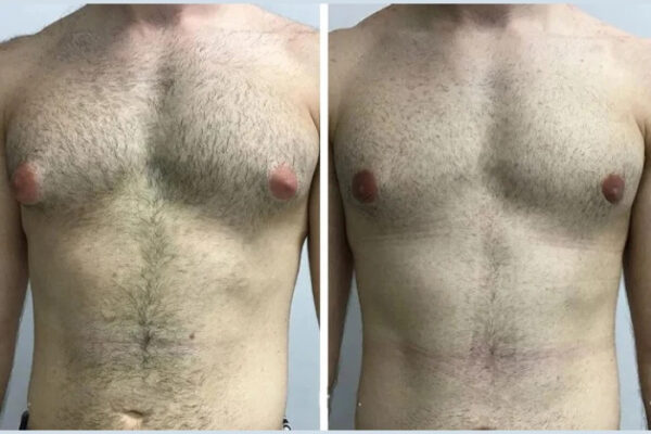 Best Gynecomastia Doctors in Dubai with Unmatched Skill gynecomastia in dubai