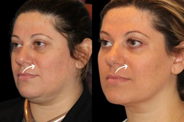 Sculptra in dubai: optimizing protocols for darker skin sculptra in dubai