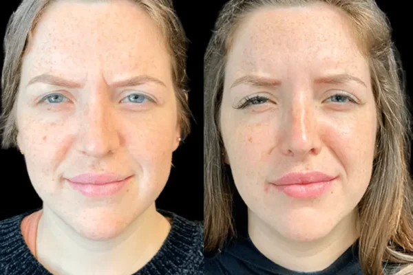 Combining Botox in Dubai with Your Anti-Aging Skincare Routine botox in dubai