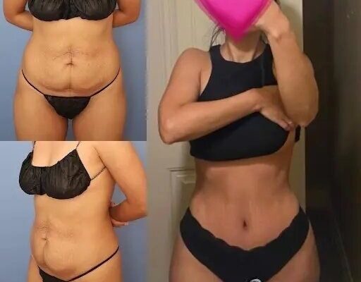 Tummy Tuck in dubai